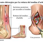 INFORTUNIO AL PIEDE PER MICHELE EMILIANO